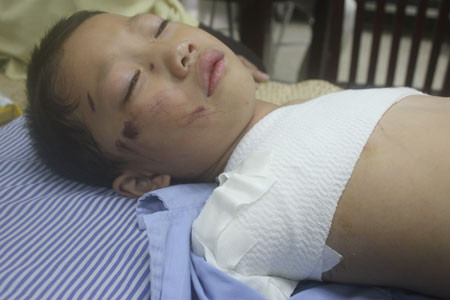 Bé 5 tuổi bị gấu nuôi cắn nát 2 tay 1 Bé 5 tuổi bị gấu nuôi cắn nát 2 tay 1