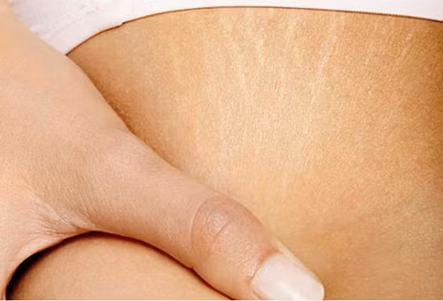Bí quyết để trị rạn da hiệu quả tại nhà