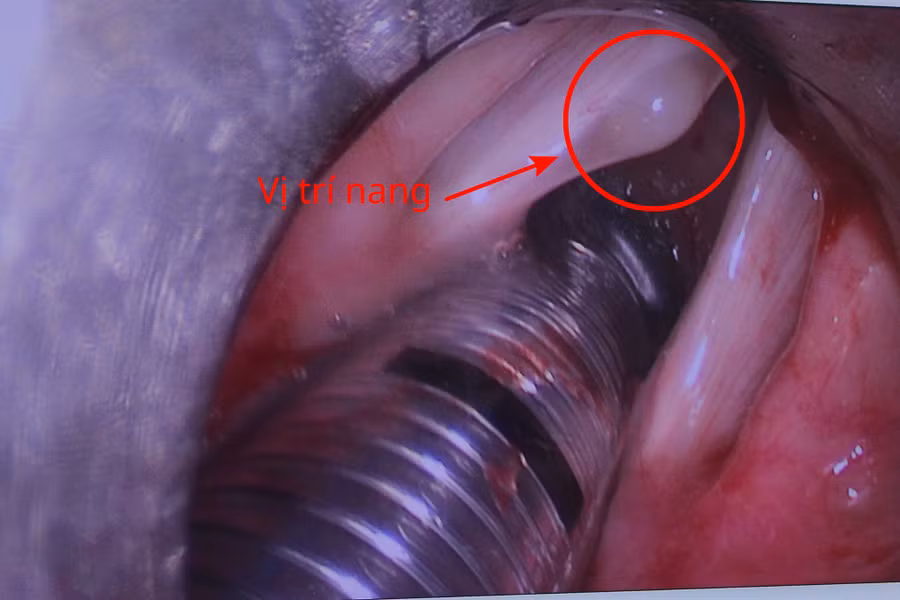 Hình ảnh khối u nang. 