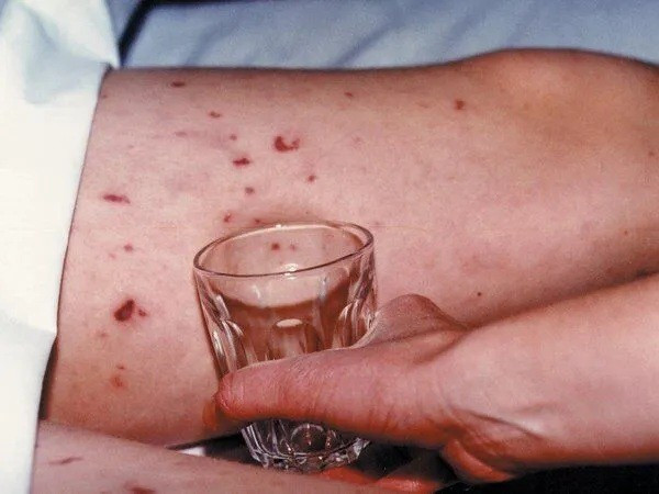 Dấu hiệu mắc bệnh viêm não mô cầu. 