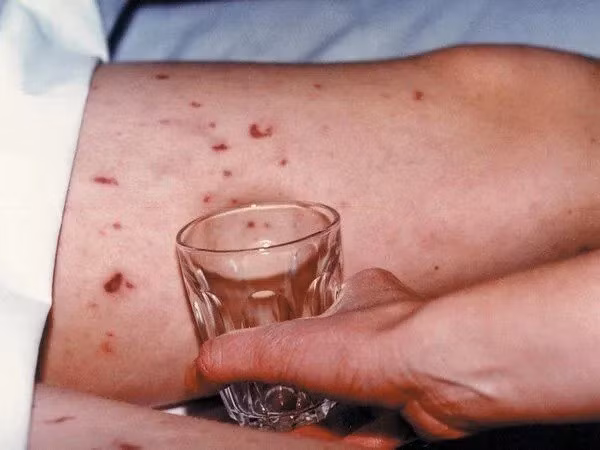 Dấu hiệu mắc bệnh viêm não mô cầu. 