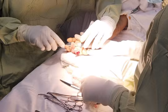 Các bác sĩ thực hiện cấp cứu vi phẫu khẩn cấp bảo tồn ngón tay cho bệnh nhân. 