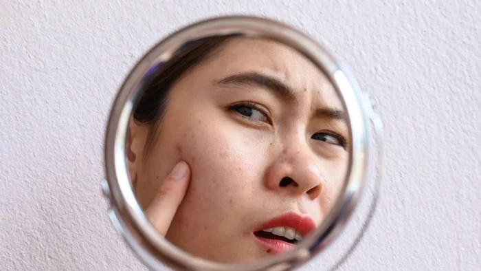 Phản ứng đầu tiên của nhiều người khi đối mặt với mụn trứng cá là nặn và gãi bằng tay. (Ảnh: ITN)