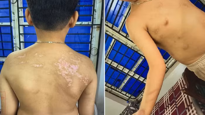 Cháu N.Đ.B.K có 21 vết sẹo và 20 vết rối loạn sắc tố da màu nâu.