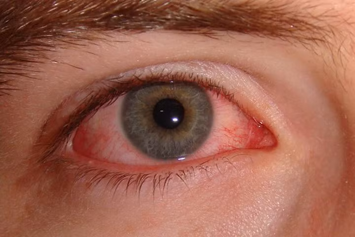 Bệnh thủy đậu chưa giảm, đau mắt đỏ, ho gà lại "tấn công"