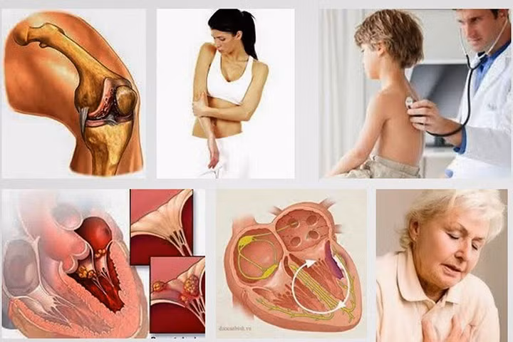 Chuyên gia tim mạch nói về bệnh "thấp khớp đớp tim"