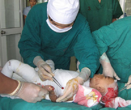 Mẹ sơ sẩy, con 14 tháng tuổi ngã vào nồi canh vừa sôi gây bỏng nặng - Ảnh 1 Me so say, con 14 thang tuoi nga vao noi canh vua soi gay bong nang - Anh 1