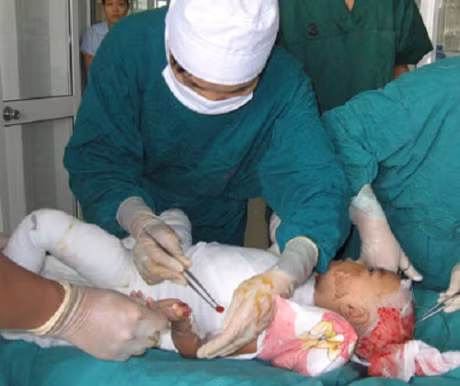 Me so say, con 14 thang tuoi nga vao noi canh vua soi gay bong nang - Anh 1