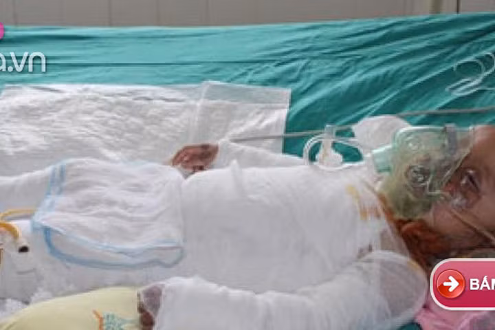 Mẹ sơ sẩy, con 14 tháng tuổi ngã vào nồi canh vừa sôi gây bỏng nặng