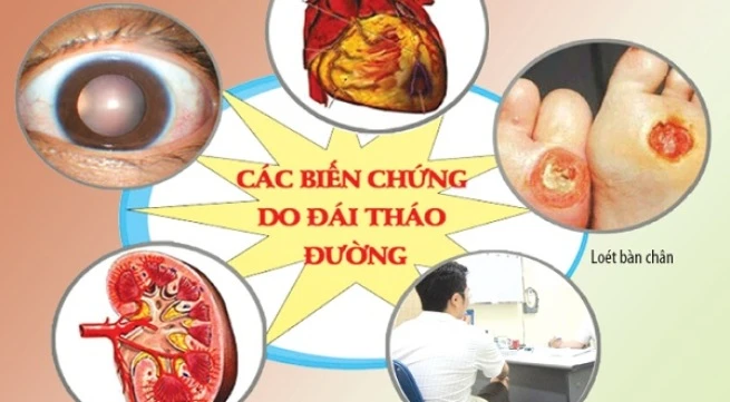 10 cách phòng biến chứng đái tháo đường