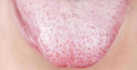 Màu sắc của lưỡi cảnh báo một số bệnh - Ảnh 1 Mau sac cua luoi canh bao mot so benh - Anh 1