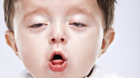 Bệnh nguy hiểm có thể đi kèm với viêm phổi, phụ huynh phải biết - Ảnh 1 Benh nguy hiem co the di kem voi viem phoi, phu huynh phai biet - Anh 1