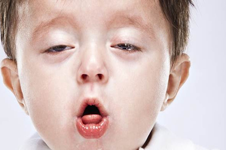 Bệnh nguy hiểm có thể đi kèm với viêm phổi, phụ huynh phải biết