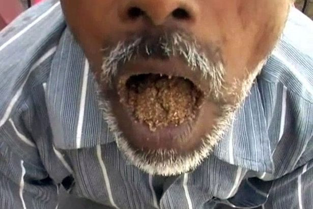 Người đàn ông kỳ quái ăn cát, sỏi đá suốt 25 năm