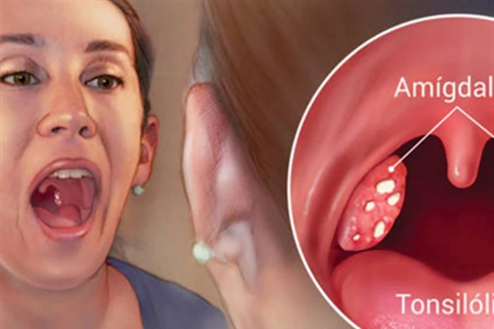5 cách loại bỏ hôi miệng và kết sỏi amidan