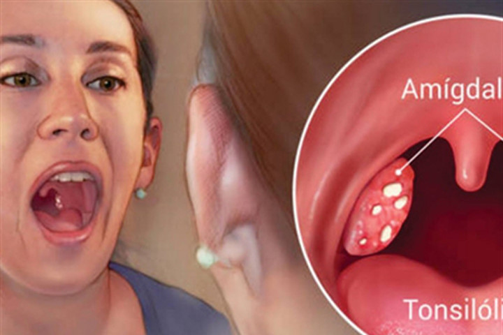 5 cách loại bỏ hôi miệng và kết sỏi amidan