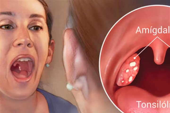 5 cách loại bỏ hôi miệng và kết sỏi amidan