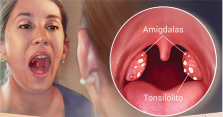5 cách loại bỏ hôi miệng và kết sỏi amidan - Ảnh 1 5 cach loai bo hoi mieng va ket soi amidan - Anh 1