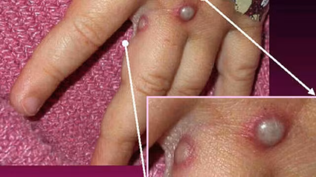 Bệnh đậu mùa khỉ đã lan tới Mỹ.