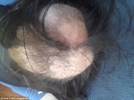 Tóc của Tiarne rụng nhiều vì thói quen giật tóc