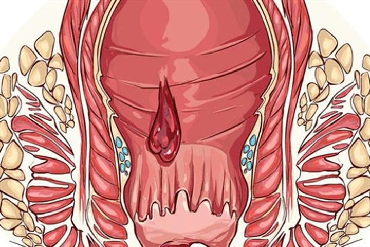 Thực phẩm phòng căn bệnh mà cứ 10 người Việt thì có 5 người mắc phải