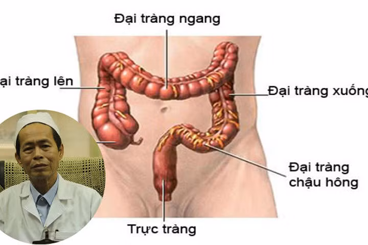 Tuân thủ những nguyên tắc này, bệnh nhân ung thư trực tràng sống khỏe đến tuổi 70