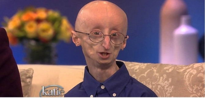 10 căn bệnh hiếm gặp ít người biết tới - Ảnh 3 10 căn bệnh hiếm gặp ít người biết tới - Ảnh 3