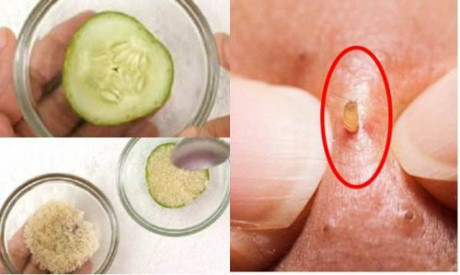 Dùng dưa chuột chấm đường chà vào mặt mụn đầu đen tự bong hết - Ảnh 2 Dung dua chuot cham duong cha vao mat mun dau den tu bong het - Anh 2