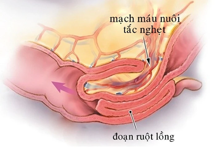 Cách phát hiện và ngăn ngừa lồng ruột ở trẻ