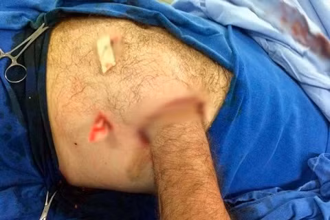 Ca phẫu thuật ghép tay vào ổ bụng khó tin của Carlos Mariotti.