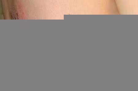 Bệnh zona có thể xảy ra bất cứ nơi nào trên cơ thể.