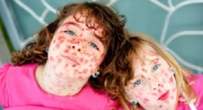 Hơn 100 quốc gia có trường hợp mắc sởi. Hơn 100 quốc gia có trường hợp mắc sởi.