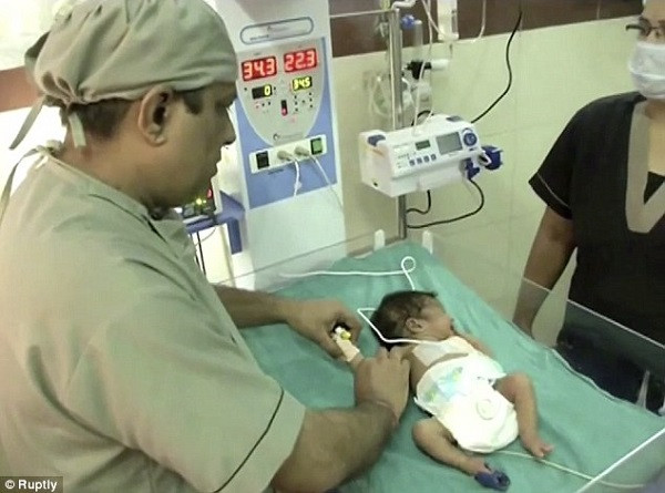 Bé sơ sinh 3 cánh tay chào đời ở Ấn Độ