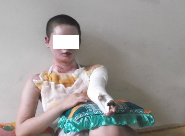 Mừng tốt nghiệp, tân cử nhân bỏng nặng vì bếp cồn - 2