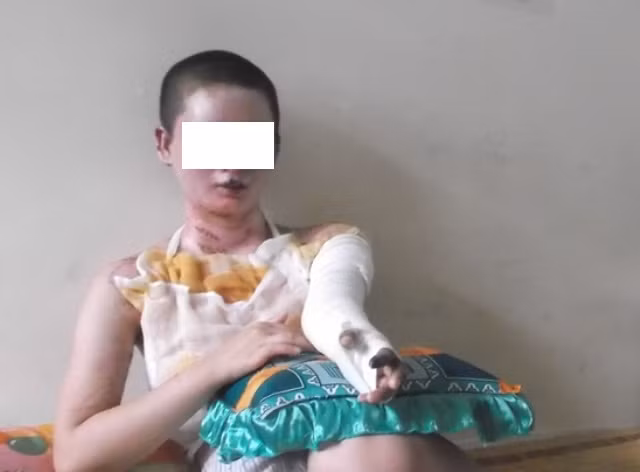 Mừng tốt nghiệp, tân cử nhân bỏng nặng vì bếp cồn - 2