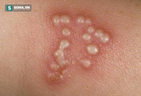 6 bài thuốc điều trị mụn rộp đơn giản và hiệu quả ngay tại nhà - Ảnh 2 6 bai thuoc dieu tri mun rop don gian va hieu qua ngay tai nha - Anh 2