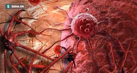 Bac si benh vien Viet Duc khuyen 6 dieu nen lam ngay de benh ung thu khong go cua - Anh 2