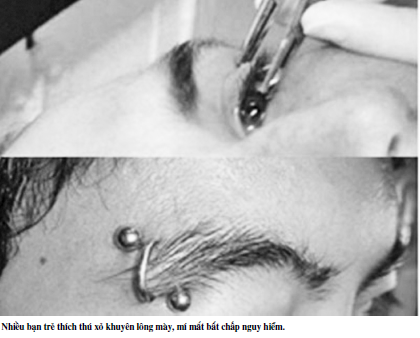 Cảnh báo mù mắt vì mốt xỏ khuyên lông mày, mí mắt - Ảnh 1