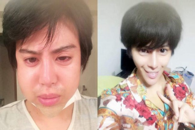 Allen là cái tên quen thuộc với giới trẻ Nhật Bản và cũng thường xuất hiện trong các chương trình truyền hình. Anh chàng đã thực hiện hơn 40 ca phẫu thuật thẩm mỹ khiến khuôn mặt thay đổi hoàn toàn: cằm nhọn hoắt đến dị dạng, đôi mắt to, mũi cao... quý ông thẩm mỹ