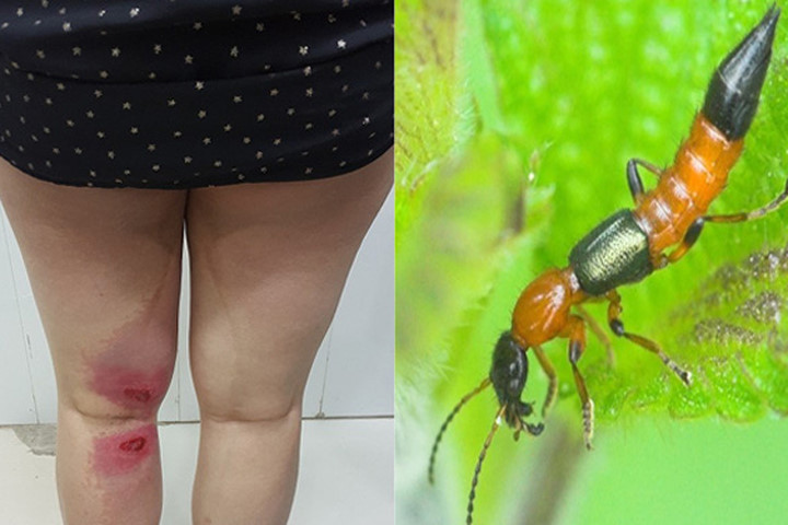 Bị kiến ba khoang đốt mà chữa kiểu này thì hối hận cũng không kịp