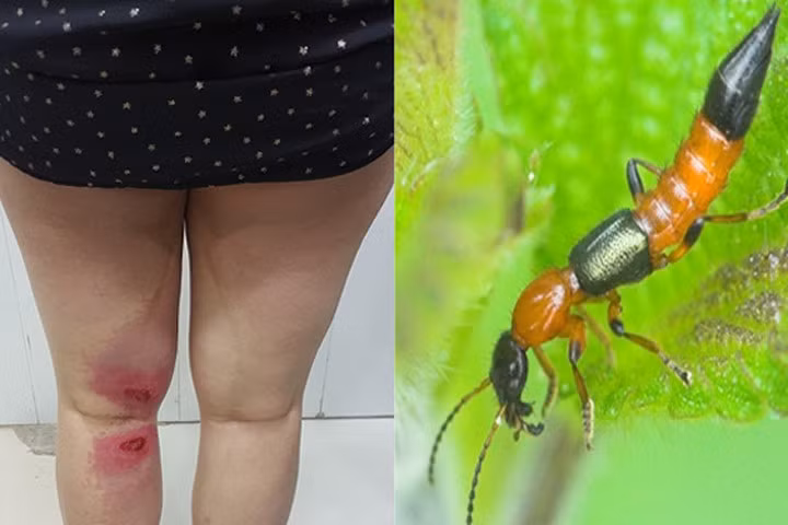 Bị kiến ba khoang đốt mà chữa kiểu này thì hối hận cũng không kịp