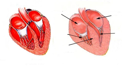 Tim bình thường (trái) và cơ tim bị giãn (phải).
