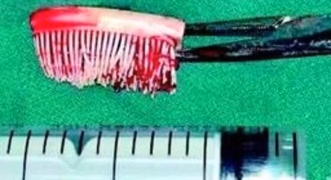 Bàn chải kẹt trong miệng bé sơ sinh 7 tháng trời không ai biết