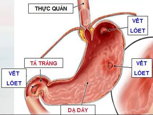 Những lưu ý quan trọng khi bị viêm loét dạ dày