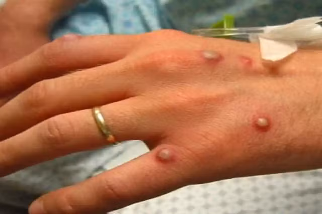 Bệnh đậu mùa khỉ.