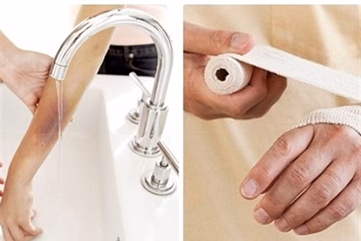 Ngâm trong nước lạnh là cách mẹ Xì Trum cứu con khi bị bỏng phích nước