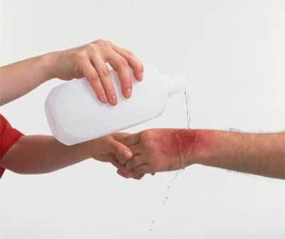 Kinh nghiệm xương máu của mẹ Việt khi cứu con bị bỏng phích nước - Ảnh 2 Kinh nghiem xuong mau cua me Viet khi cuu con bi bong phich nuoc - Anh 2