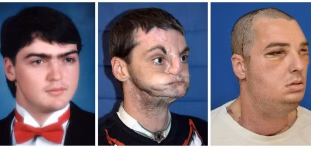 HÌnh ảnh người hiến tặng và gương mặt của Richard Norris khi chưa phẫu thuật và khi đã phục hồi. Ảnh: AFP/Getty Images.
