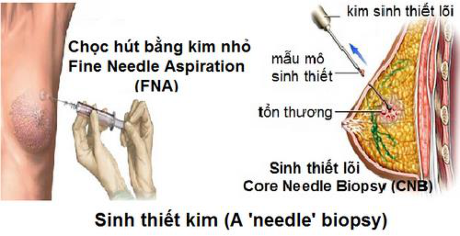 Phát hiện sớm ung thư cần làm các xét nghiệm nào? - Ảnh 1 Phat hien som ung thu can lam cac xet nghiem nao? - Anh 1