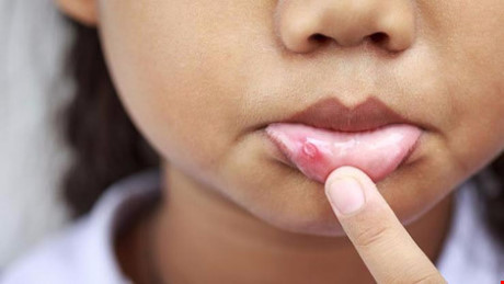 6 cách tự nhiên chữa lở miệng - Ảnh 2 6 cach tu nhien chua lo mieng - Anh 2